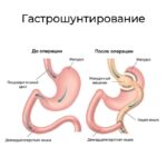 Минигастрошунтирование последствия: честный взгляд врача на риски и реальность