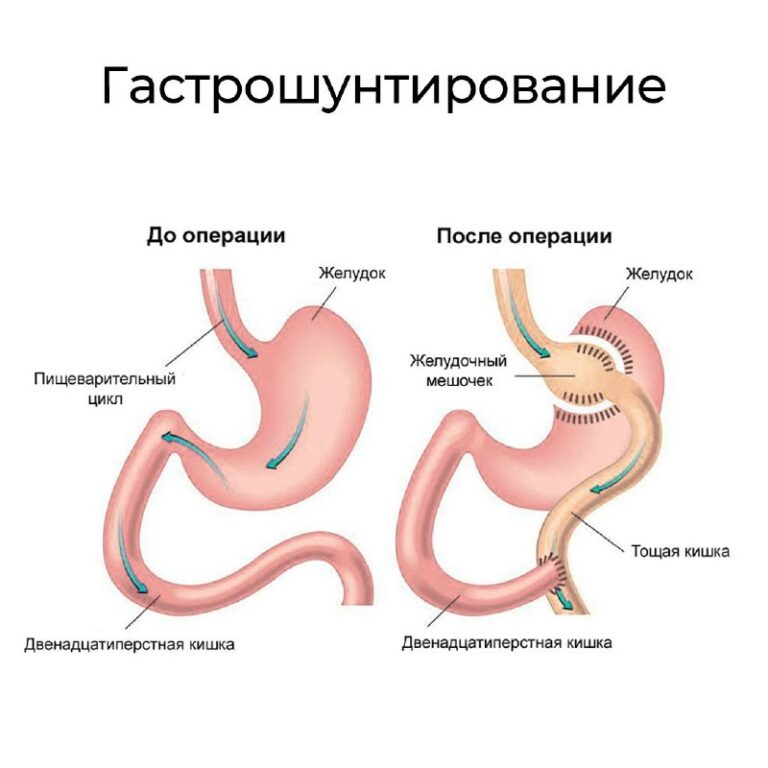 Минигастрошунтирование последствия: честный взгляд врача на риски и реальность