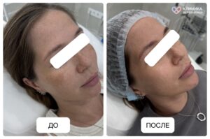 Лазерное удаление пигментации и пятен постакне