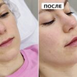Увеличение губ филлером: мифы и реальность