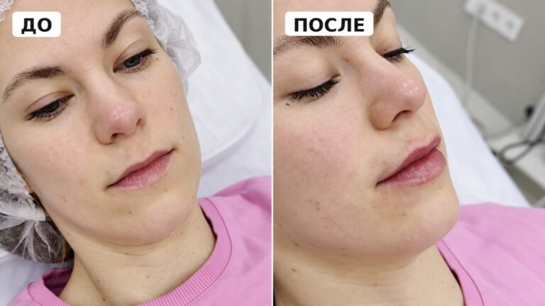 Увеличение губ филлером: мифы и реальность